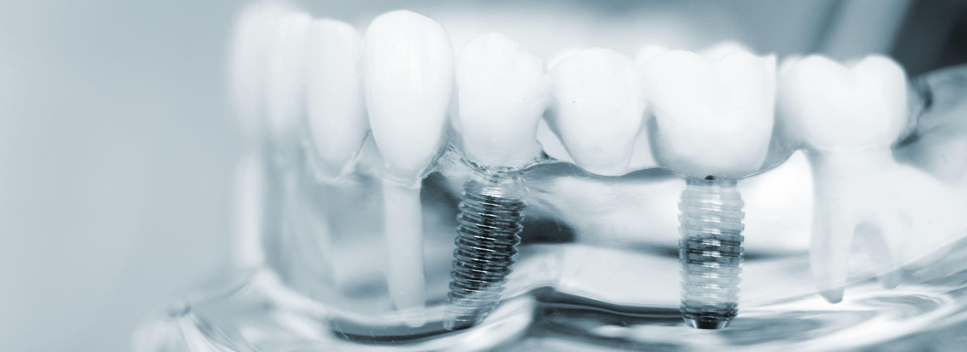 Smile Philosophy Dental Care | Ceramic Crowns, Veneers and Crowns amp Caps
