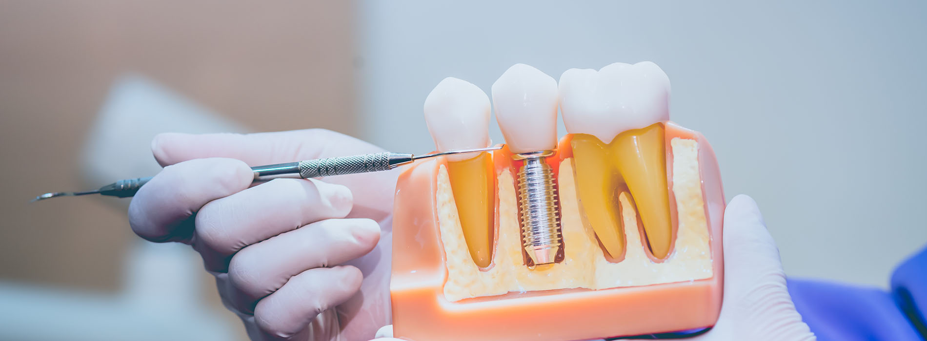 Smile Philosophy Dental Care | Crowns amp Caps, Dental Cleanings and Ceramic Crowns